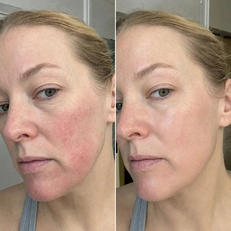 Side-by-side facial skin comparison showing different levels of visible dryness and redness