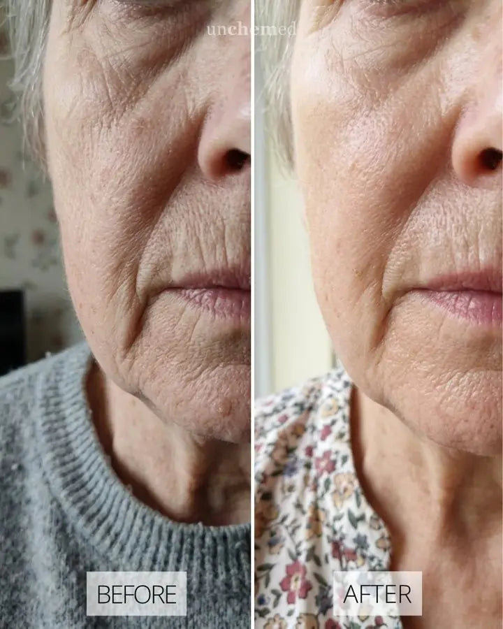 Before and after skin